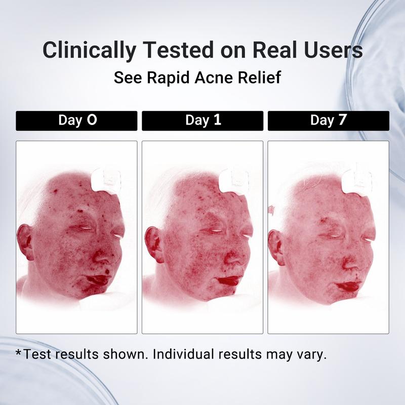 Acne Spot Drying Lotion