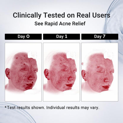 Acne Spot Drying Lotion