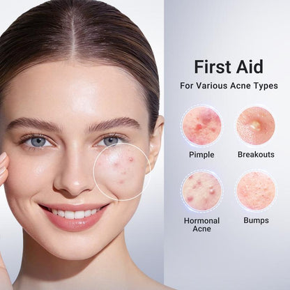 Acne Spot Drying Lotion